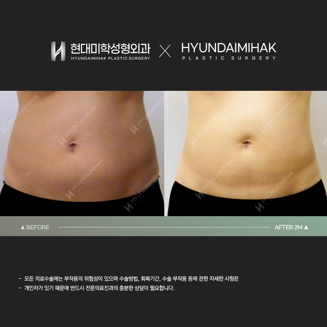Abdominal liposuction, 2 months after surgery