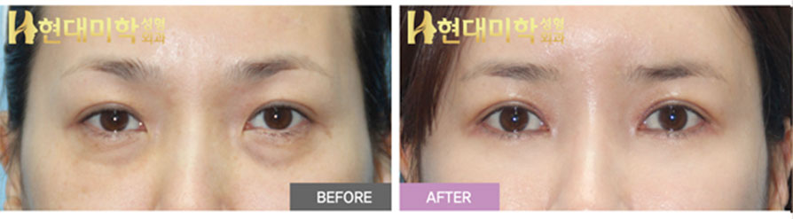 Incision Double-Eyelid Surgery, Ptosis Correction, Lower Blepharoplasty, Epicanthoplasty, Lateral Canthoplasty, Lower Canthoplasty