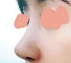 Posting my revision rhinoplasty review haha