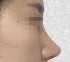 Got nose surgery at Hyundai Aesthetic Surgery on a friend's recommendation