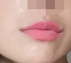 How is my lip surgery? It looks successful, right??