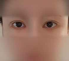 Clean removal of aegyo filler