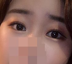 I think it is really a loss to skip eye surgery just because you have double eyelids lol (dual canthoplasty + inner-corner opening review)