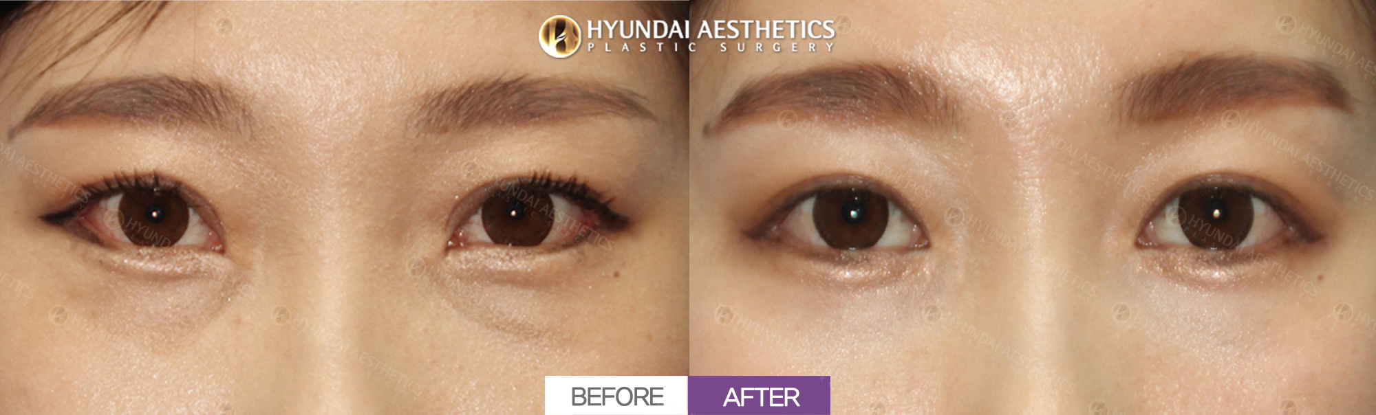 Eye Revision Surgery (Double Eyelids, Epicanthoplasty) + Lateral Canthoplasty + Lower Canthoplasty, 1 Month