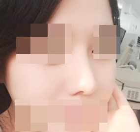 Rhinoplasty was the best — totally satisfied ♥!!