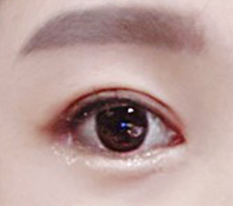 I want to admit this is a go-to place for revision eye surgery