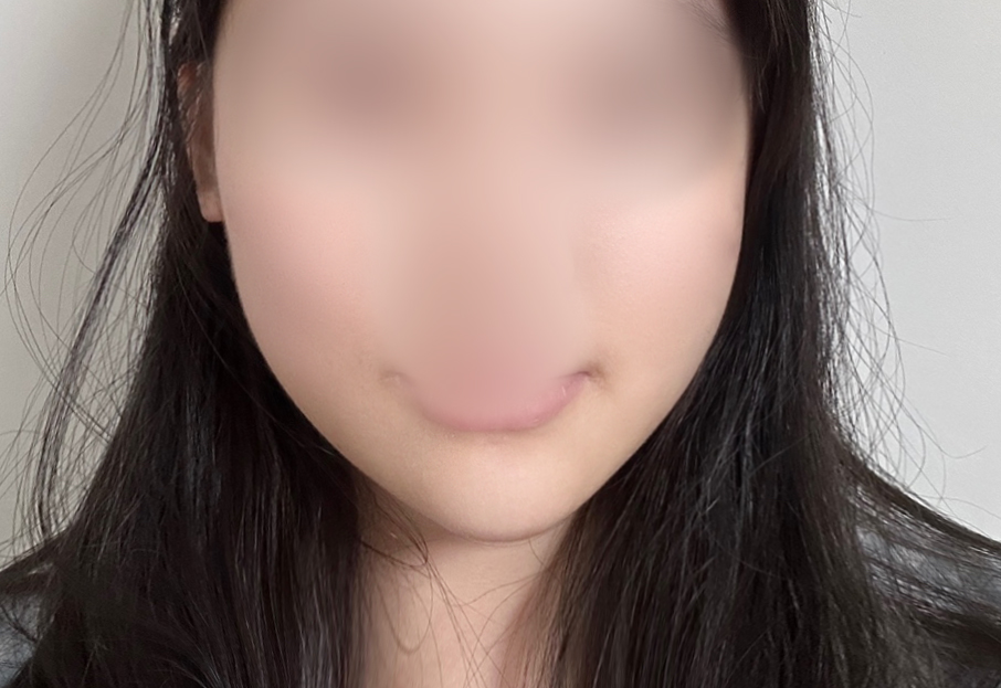 I fixed facial asymmetry with thread lifting