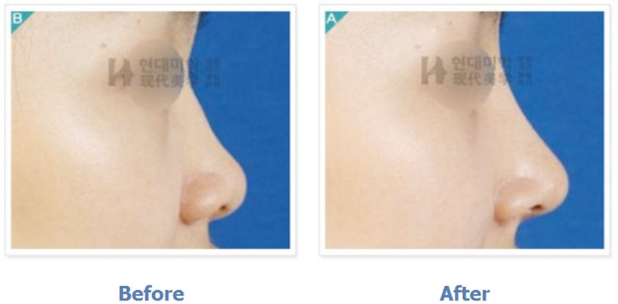 Rhinoplasty
