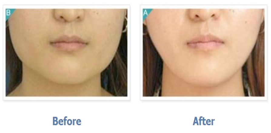 Square Jaw Surgery