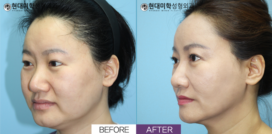 Elastikoom, Thread Lifting, Liposuction, Venus Laser