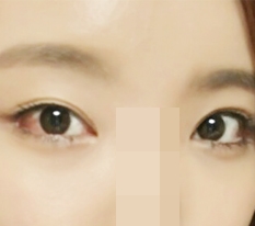 I got Perfect Big Eye + Dual Canthoplasty