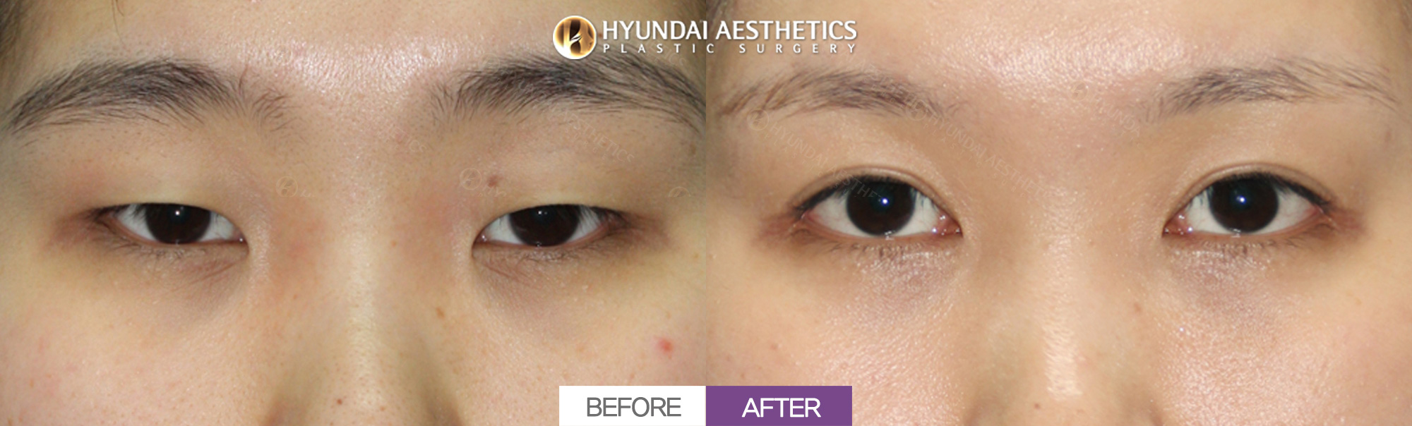 Epicanthoplasty + lateral canthoplasty + lower canthoplasty + double eyelid surgery + ptosis correction, 1 month