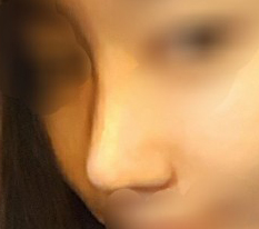 My nose surgery was a total success! Thank you, Director Kim :)