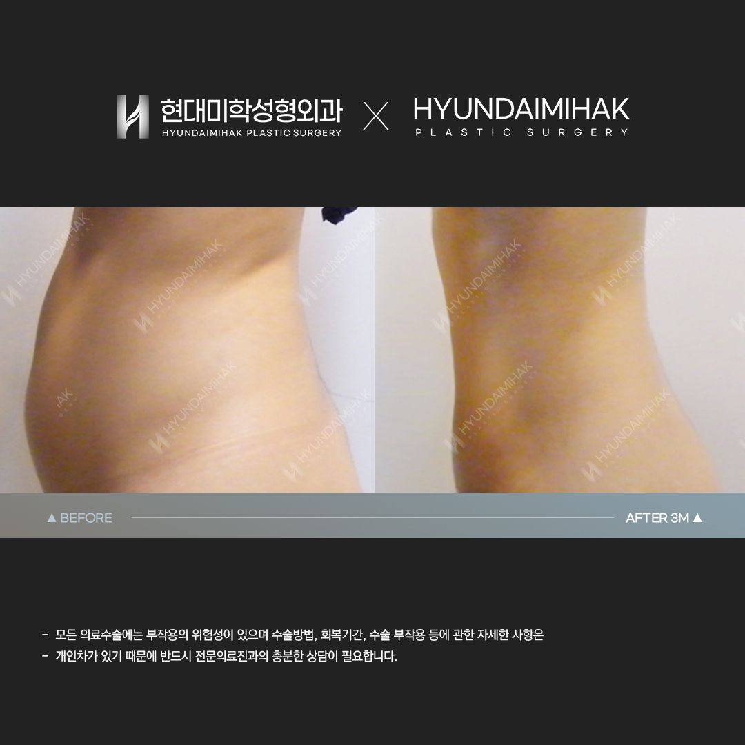 Abdominal Liposuction, 3 Months