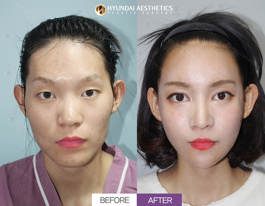 Incisional Double Eyelids + Ptosis Correction + Epicanthoplasty + Dual Canthoplasty