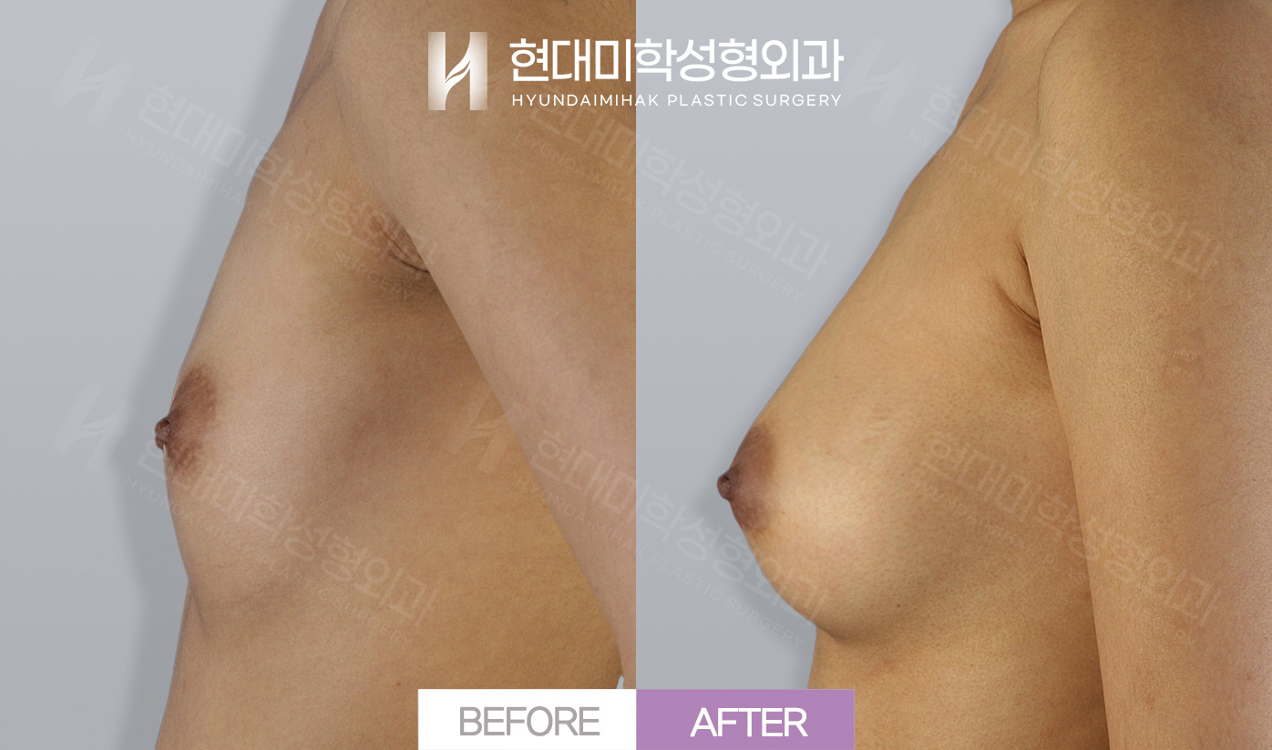 Breast Augmentation (Autologous Fat)