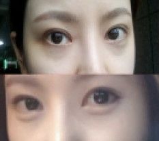 Now I'm living with clear, defined eyes, kya