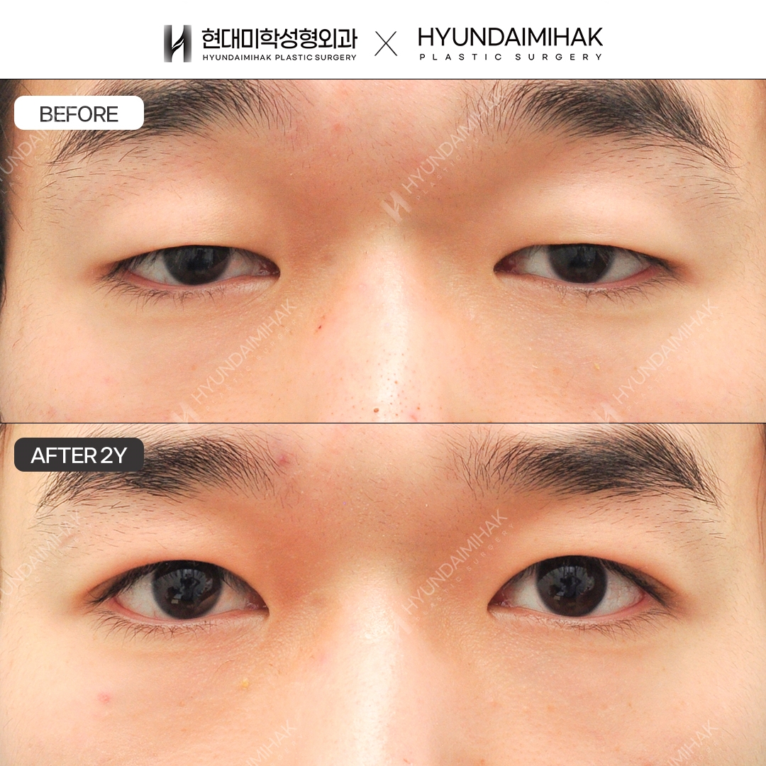 [Men's Eye Surgery] Non-Incisional Ptosis Correction