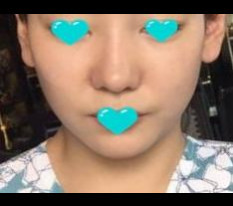 I am happy my nose became pretty!