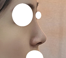 3 Months After Revision Nose Surgery
