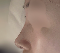 Bulbous nose surgery done!