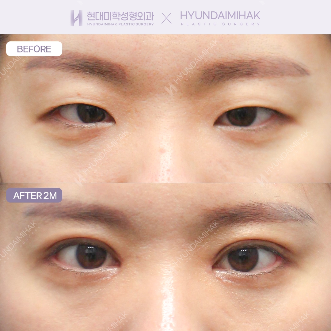 Incisional Double Eyelid + Dual Canthoplasty + Medial Epicanthoplasty
