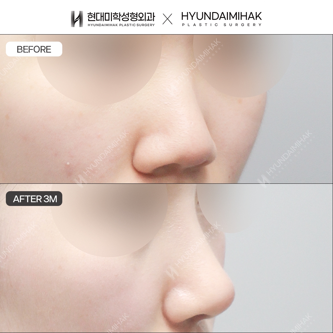 [Bulbous Nose Surgery] Bridge + Tip, 3 Months