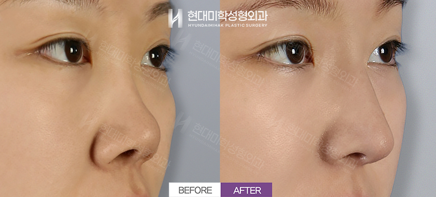 Rhinoplasty + Nasal Tip Surgery, 3 Months