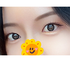 Dual canthoplasty without side effects