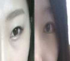 Dual canthoplasty with non-incision double eyelids! Transformed into pretty eyes~^0^