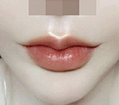It's been 3 months since my lip corner surgery ㅎㅎㅎ