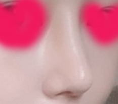 People around me went wild after seeing my nose lol