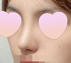 I think my satisfaction with getting my nose done is really very high ><