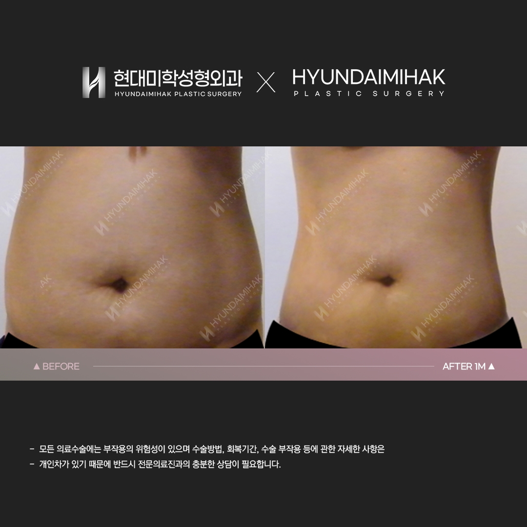 Abdominal liposuction, 1 month post-op