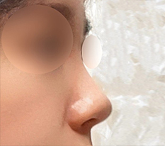 Surgery over filler bbb