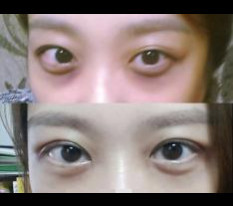 I got double eyelids with the non-incision suture method @_@