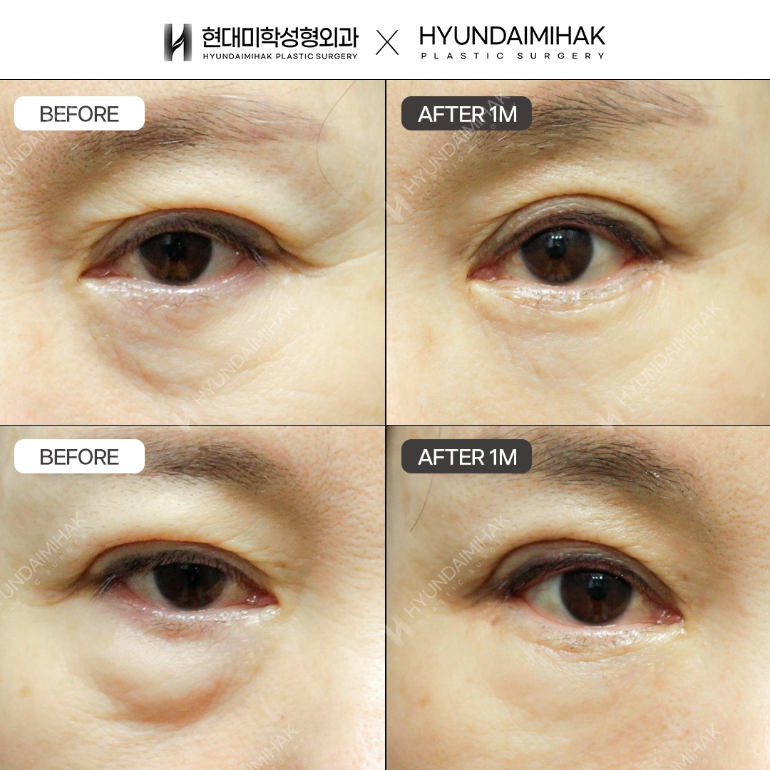[Middle-aged eye surgery] Upper blepharoplasty + lower blepharoplasty + under-eye fat repositioning