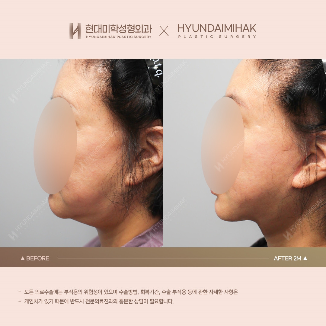 [Anti-Aging Surgery] Thread Lift, 1 Month Post-Op
