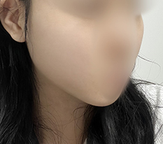 My face got slimmer!!