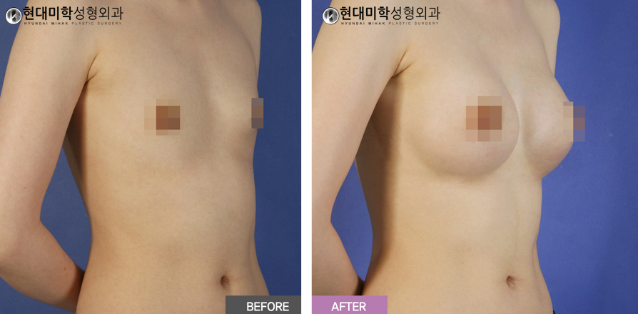 Breast Augmentation Surgery