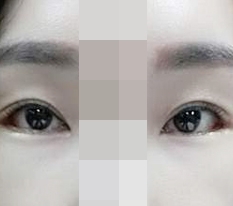 Lateral canthoplasty & lower canthoplasty ♥~