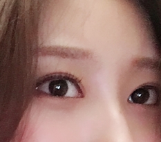 Eye surgery is definitely Hyundai Aesthetic Surgery~