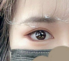 Looks like my eye revision surgery turned out well, right??