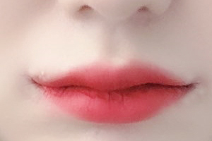 I Am Finally Posting My Mouth Corner Surgery Review