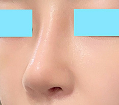 Posting my revision nose-surgery review