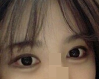 My eye surgery review~