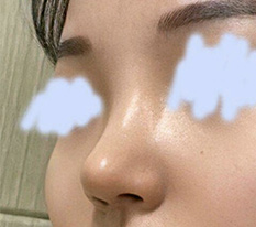 One-month nose surgery review ^^
