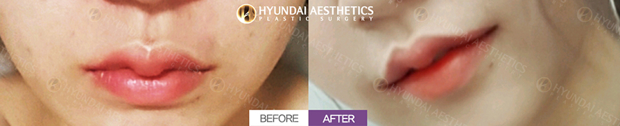 Mouth Corner Lift + Marionette Lines + Lateral Philtrum