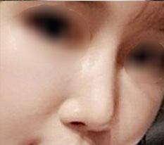 I had revision rhinoplasty at Hyundai Aesthetic Surgery and am completely satisfied^^
