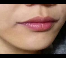 Lip corner surgery is the best!